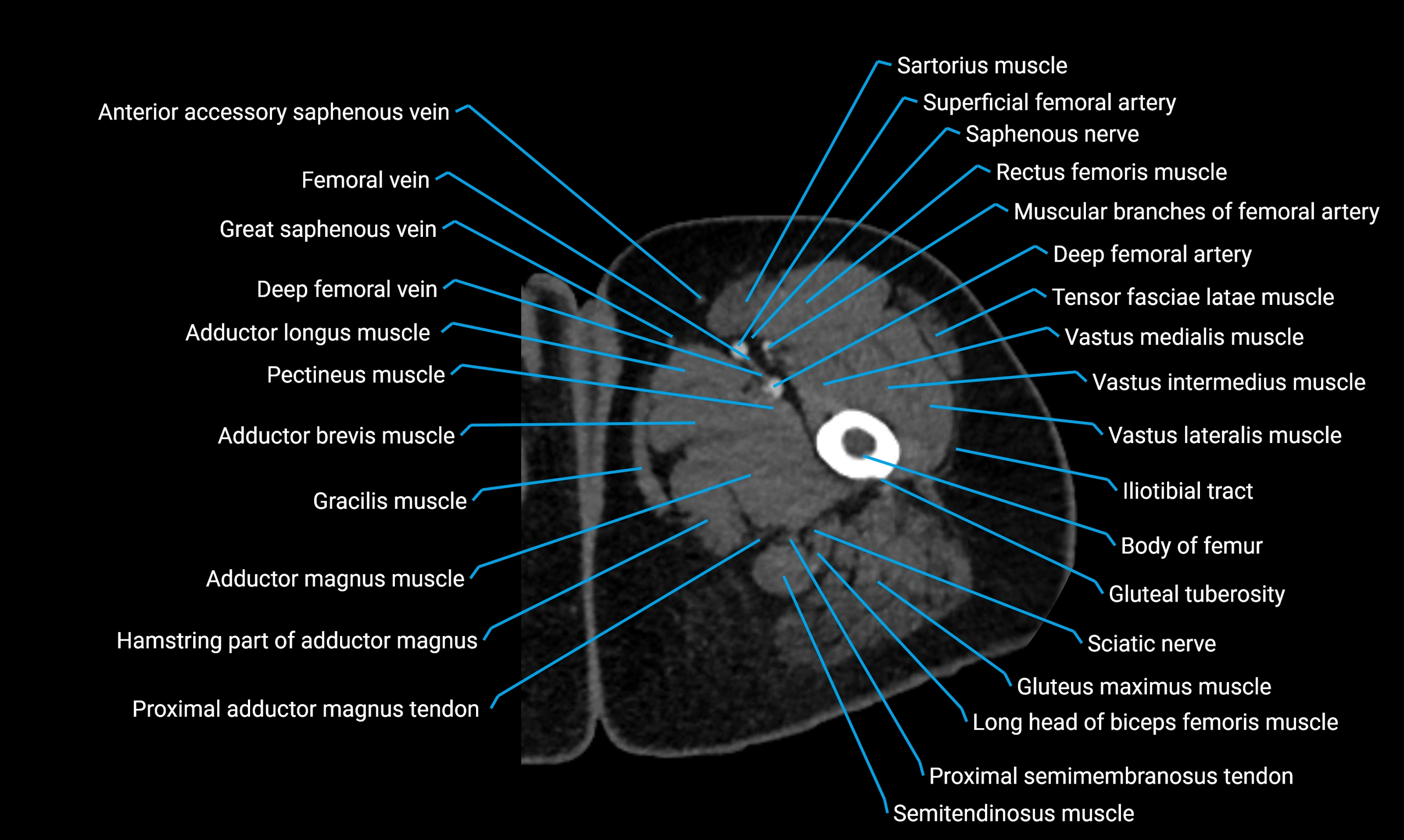 CT thigh axial cross sectional anatomy labelled image_24 (2).webp